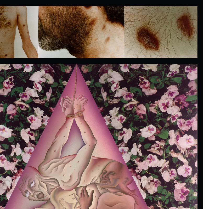 Mixed media work with emaciated nude figures entwined inside a pink triangle on a floral background with three photographs of lesions on various parts of a man's body above